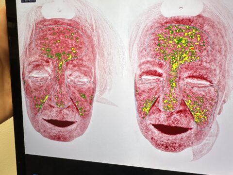 Mesoterapia tulos