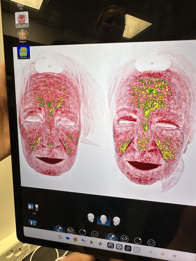 Mesoterapia ja yllätystulos