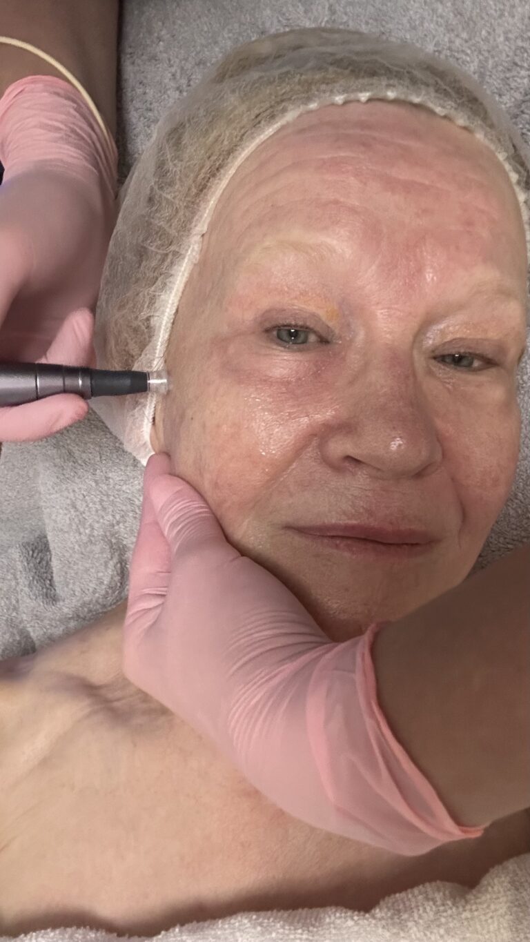 Dermatude, kanavointihoito ilman neuloja