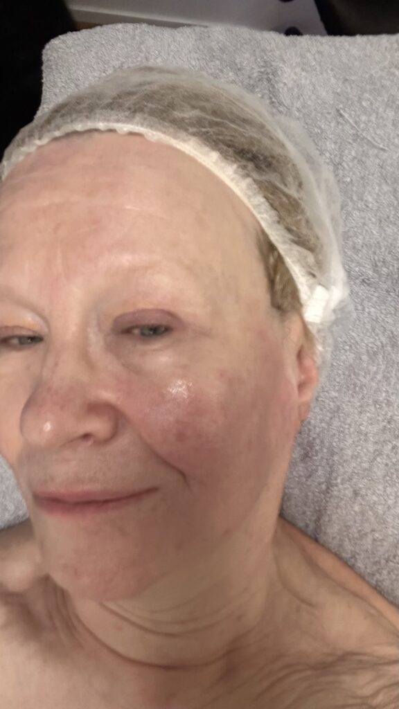 Dermatude hoidon jälkeen